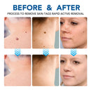 2 IN 1 Auto Micro Skin Tag Remover Device Standard And Micro Skin Tag Removal Kit Adult Mole Wart Remover Face Care Beauty Tools