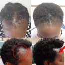 Baldness Treatment Hair Health Care nourishing formula